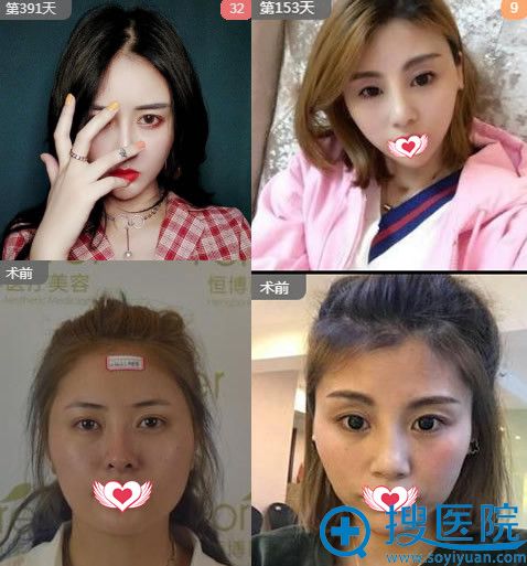 成都恒博整容效果如何?看李烈自体脂肪填充全脸案例效果对比图 成都恒博整容效果如何?看李烈自体脂肪填充全脸案例效果对比图