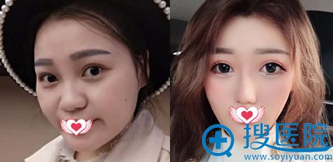 成都恒博整容院怎么样?看李烈面部吸脂案例来验证 成都恒博整容院怎么样?看李烈面部吸脂案例来验证