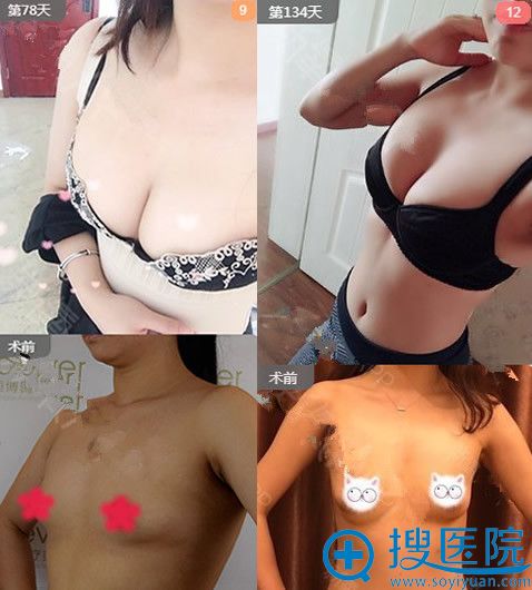 李烈自体脂肪填充丰胸案例 李烈自体脂肪填充丰胸案例