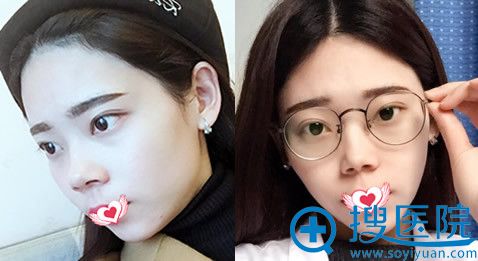 院长李烈自体脂肪丰下巴术前术后对比案例 院长李烈自体脂肪丰下巴术前术后对比案例
