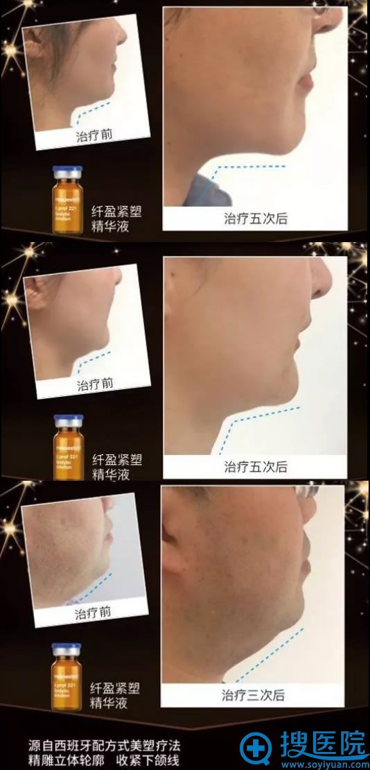 北京丽都纤颜紧塑针真人案例效果 北京丽都纤颜紧塑针真人案例效果