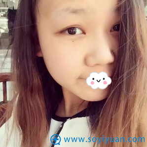 不喜欢朋友在湖州心悦割双眼皮效果到湖州曙光让蔡茂季做眼综合
