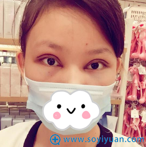 湖州曙光蔡茂季眼综合真人案例术后效果 湖州曙光蔡茂季眼综合真人案例术后效果
