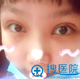 湖州曙光蔡茂季双眼皮+开眼角+提肌案例效果图 湖州曙光蔡茂季双眼皮+开眼角+提肌案例效果图