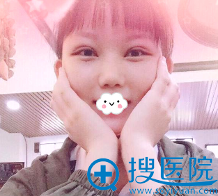 湖州曙光双眼皮怎么样?蔡茂季眼综合真人案例 湖州曙光双眼皮怎么样?蔡茂季眼综合真人案例