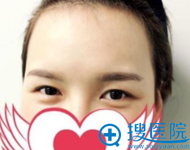 快看我在亳州缔美整形做眼综合案例图,术后1天感觉双眼皮失败