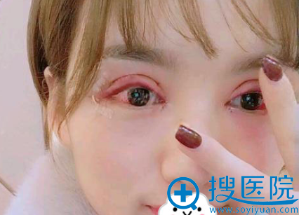 亳州缔美双眼皮真人案例 亳州缔美双眼皮真人案例