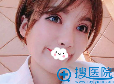 亳州缔美切开双眼皮+开内外眼角真实恢复过程图 亳州缔美切开双眼皮+开内外眼角真实恢复过程图