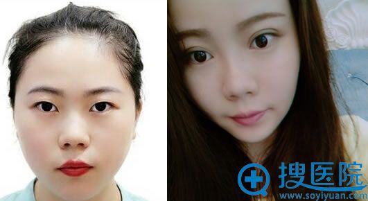 <!--<i data=20240710 data-id=7735></i>-->马晓艳双眼皮案例 <!--<i data=20240710 data-id=7735></i>-->马晓艳双眼皮案例