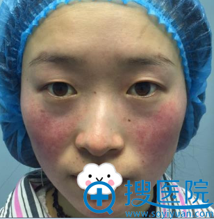 <!--<i data=20240710 data-id=9146></i>-->双眼皮整形怎么样?张鹏真人案例 <!--<i data=20240710 data-id=9146></i>-->双眼皮整形怎么样?张鹏真人案例