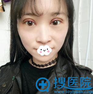 <!--<i data=20240710 data-id=9146></i>-->张鹏双眼皮+开眼角术后4天效果 <!--<i data=20240710 data-id=9146></i>-->张鹏双眼皮+开眼角术后4天效果