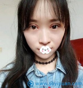 <!--<i data=20240710 data-id=9146></i>-->张鹏双眼皮+开眼角恢复效果图 <!--<i data=20240710 data-id=9146></i>-->张鹏双眼皮+开眼角恢复效果图