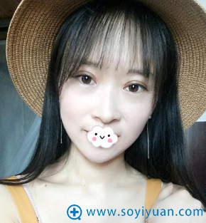 <!--<i data=20240710 data-id=9146></i>-->张鹏切开双眼皮+开眼角案例 <!--<i data=20240710 data-id=9146></i>-->张鹏切开双眼皮+开眼角案例
