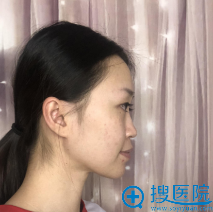 上次找大连沙医生张建光做的双眼皮不错这次准备找付德林做隆鼻