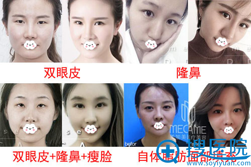 深圳美加美双眼皮、隆鼻真人案例效果对比图 深圳美加美双眼皮、隆鼻真人案例效果对比图