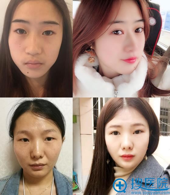 武汉卓美吴秀英院长割双眼皮案例 武汉卓美吴秀英院长割双眼皮案例
