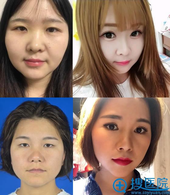 武汉卓美吴秀英双眼皮开眼角案例 武汉卓美吴秀英双眼皮开眼角案例