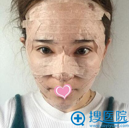 在上海伊莱美王世主任的建议下把自体脂肪填充和隆鼻一起做了