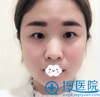 看下济南美容整形医院周先超院长给我割双眼皮+开眼角效果好吗