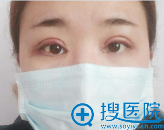 <!--<i data=20240710 data-id=13777></i>-->双眼皮怎么样?眼综合真人案例效果图 <!--<i data=20240710 data-id=13777></i>-->双眼皮怎么样?眼综合真人案例效果图