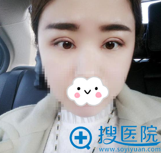 在<!--<i data=20240710 data-id=13777></i>-->割双眼皮+开眼角+去脂去皮 在<!--<i data=20240710 data-id=13777></i>-->割双眼皮+开眼角+去脂去皮