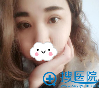 <!--<i data=20240710 data-id=13777></i>-->眼综合整形术后恢复过程图 <!--<i data=20240710 data-id=13777></i>-->眼综合整形术后恢复过程图