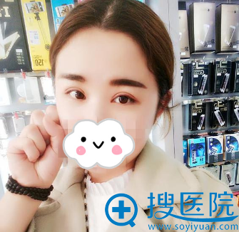 <!--<i data=20240710 data-id=13777></i>-->双眼皮+开内眼角效果 <!--<i data=20240710 data-id=13777></i>-->双眼皮+开内眼角效果