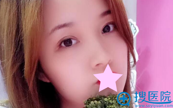 衡阳美莱全切双眼皮+开眼角两个月 衡阳美莱全切双眼皮+开眼角两个月