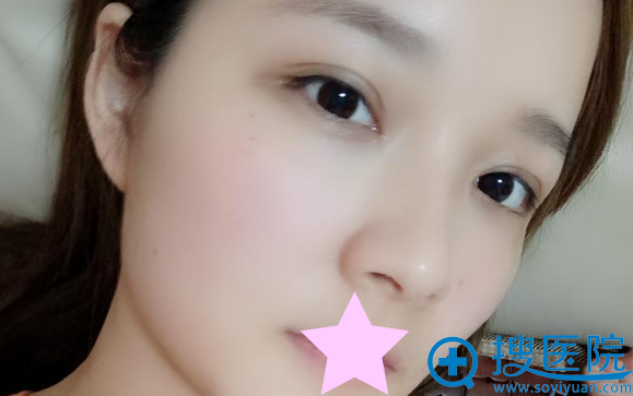 美莱割双眼皮一个月后的恢复效果 美莱割双眼皮一个月后的恢复效果