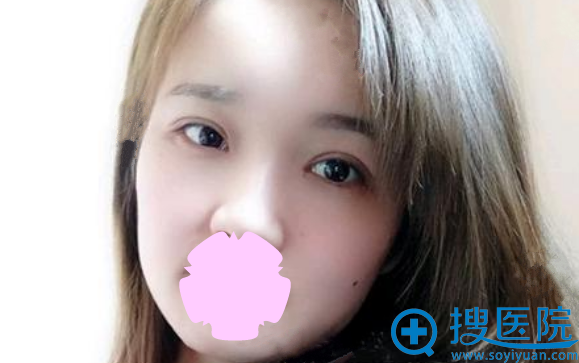 切开双眼皮第七天拆线后图片 切开双眼皮第七天拆线后图片