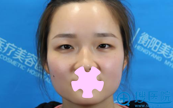 衡阳美莱整形医院割双眼皮前 衡阳美莱整形医院割双眼皮前