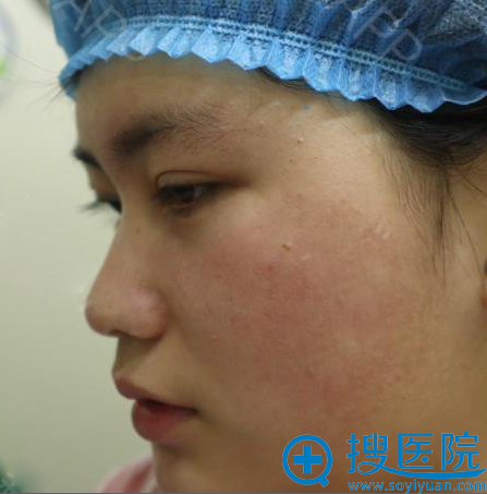 之前在上海明桥整形医院做过双眼皮这次又来找孙超医生做隆鼻