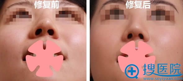 李智明院长隆鼻失败修复案例及前后对比图 李智明院长隆鼻失败修复案例及前后对比图