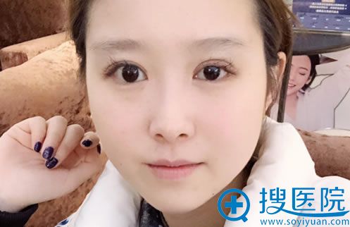 刘志刚从大连回北京奥德丽格医院坐诊了,赶紧找他做双眼皮修复