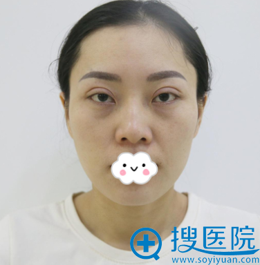 全切双眼皮太宽太深朋友说白永辉眼部修复好到济南韩式重燃希望