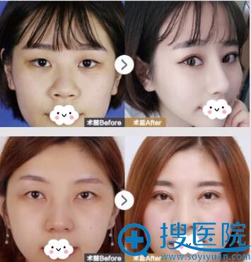 恩施天后双眼皮案例前后效果对比 恩施天后双眼皮案例前后效果对比