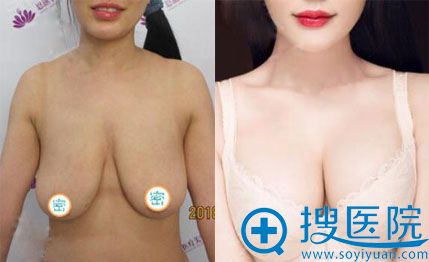 <!--<i data=20240710 data-id=11909></i>-->隆胸效果怎么样?术前术后对比图 <!--<i data=20240710 data-id=11909></i>-->隆胸效果怎么样?术前术后对比图