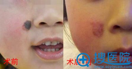 湖北激光点痣哪家好?<!--<i data=20240710 data-id=11909></i>-->真人案例对比图 湖北激光点痣哪家好?<!--<i data=20240710 data-id=11909></i>-->真人案例对比图
