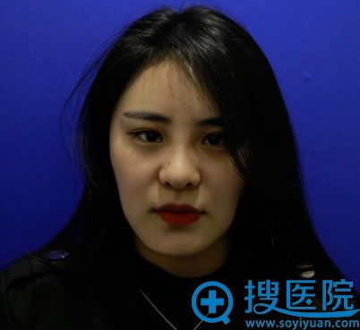 这是我在北京壹加壹医院做完自体脂肪填充和下眼下至100天效果