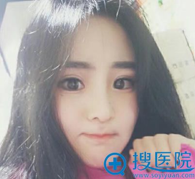 做完自体脂肪填充和下眼下至30天后 做完自体脂肪填充和下眼下至30天后