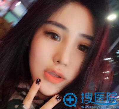 北京壹加壹张绿峰脂肪填充案例60天效果 北京壹加壹张绿峰脂肪填充案例60天效果