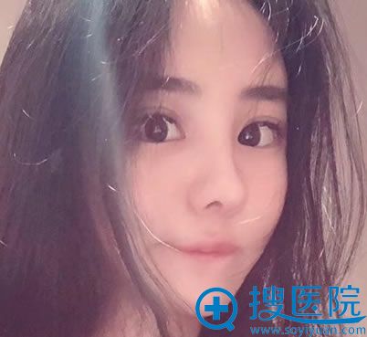 北京壹加壹面填和下眼下至案例100天效果 北京壹加壹面填和下眼下至案例100天效果