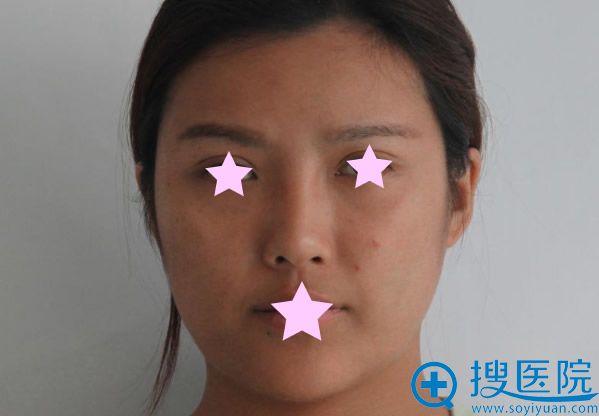 脂肪填充全脸失败后 我来无锡曼陀罗整形医院做了面部线雕提升