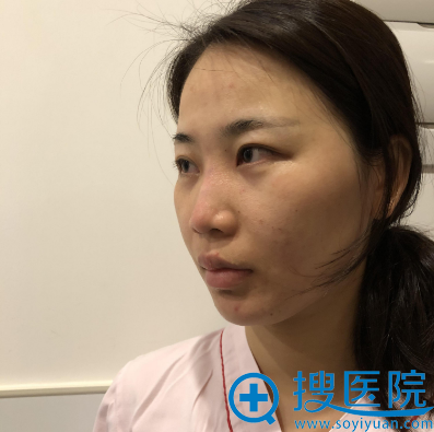 两个月前我花4万元找上海百达丽整形医院韩嘉毅做了鼻综合隆鼻