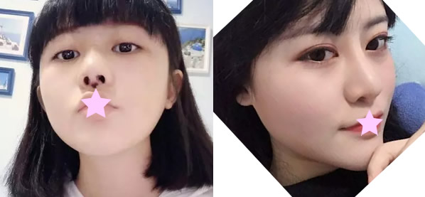 不敢晒无锡曼陀罗整形汪院长给我做鼻综合隆鼻前的照片 太丑了