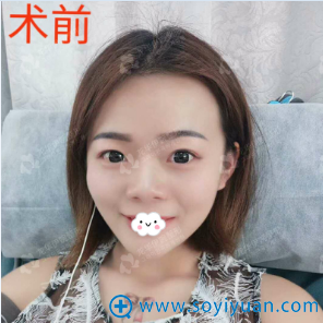 都说我去韩国整形 其实在深圳伊婉王力佳处做假体综合隆鼻了