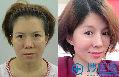 <!--<i data=20240710 data-id=13394></i>-->刘小庆脂肪填充案例 <!--<i data=20240710 data-id=13394></i>-->刘小庆脂肪填充案例