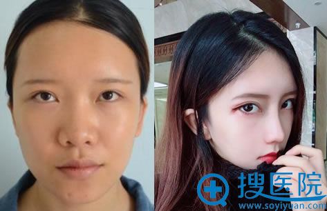 <!--<i data=20240710 data-id=13394></i>-->刘院长隆鼻案例 <!--<i data=20240710 data-id=13394></i>-->刘院长隆鼻案例