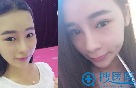 南宁美丽再造刘小庆双眼皮案例 南宁美丽再造刘小庆双眼皮案例