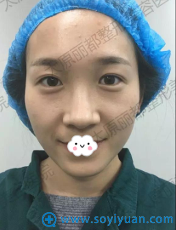<!--<i data=20240710 data-id=12271></i>-->整形医院杨明锋双眼皮真人案例 <!--<i data=20240710 data-id=12271></i>-->整形医院杨明锋双眼皮真人案例